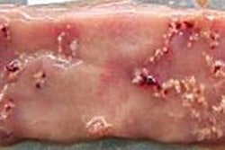 Broiler intestines with moderate necrotic enteritis lesions.