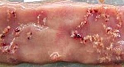 Broiler intestines with moderate necrotic enteritis lesions.