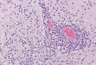 This image, captured under a microscope, shows a section of brain and spinal cord with a severe inflammatory process. The tissues tested positive for the presence of the novel sapelovirus. Paulo Arruda | Iowa State University