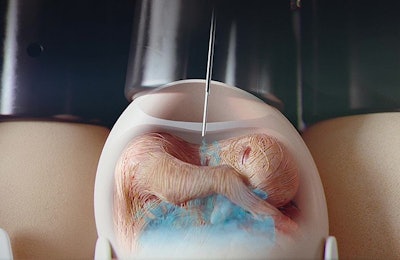 Optimal protection is only achieved when vaccines are injected into the amniotic sac or the embryo. Other locations may result in limited or no protection and my injure the embryo. | Courtesy Zoetis
